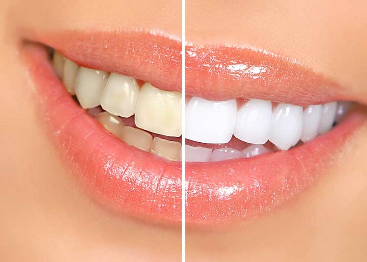 How to whiten your teeth with vinegar