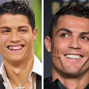 cristino-Ronaldo-With-and-without-veeners-300x300