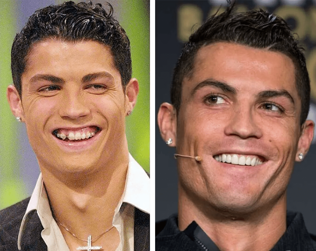cristino Ronaldo With and without veeners