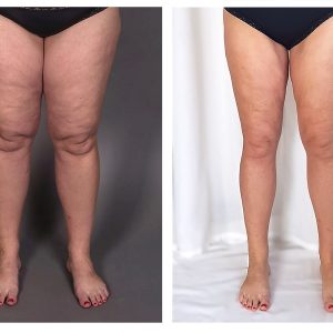 lipedema-1-300x300