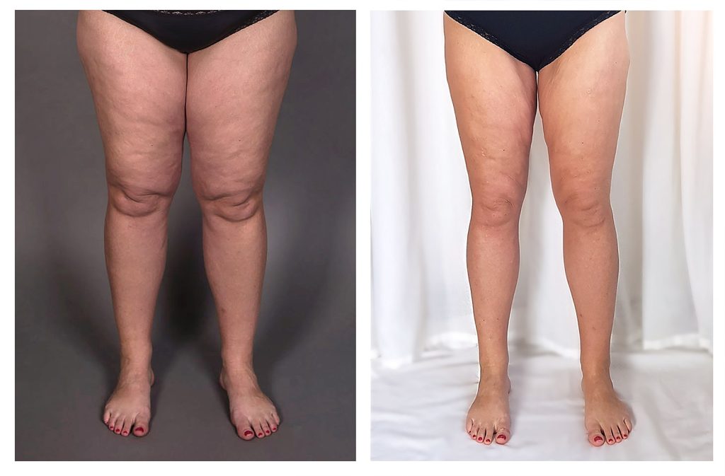 10 Celebrities With Lipedema - Their Stories And Struggles