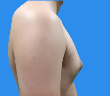 Gynecomastia