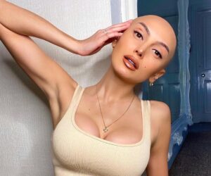 10 Famous Celebrities with Frontal Fibrosing Alopecia Revealed