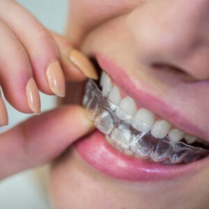 Invisalign-300x300